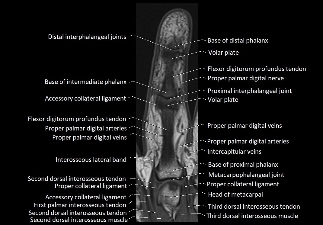 Finger anatomy coronal cross section 3TMRI labelled  image 7.webp